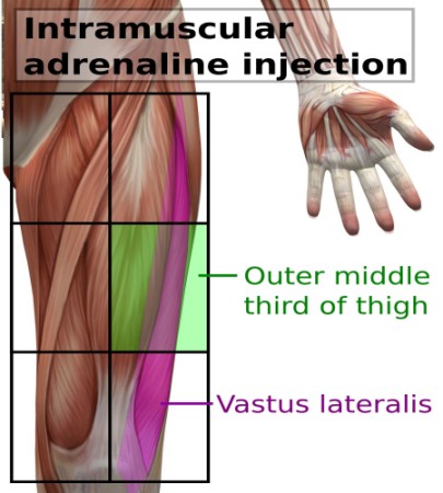 Injection Site Graph. 6 Grids Across the Upper Thigh Showing Injection Site.